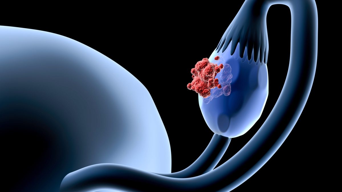 Ovarian cancer: this revolutionary implant treats and monitors the progression of the disease in real time