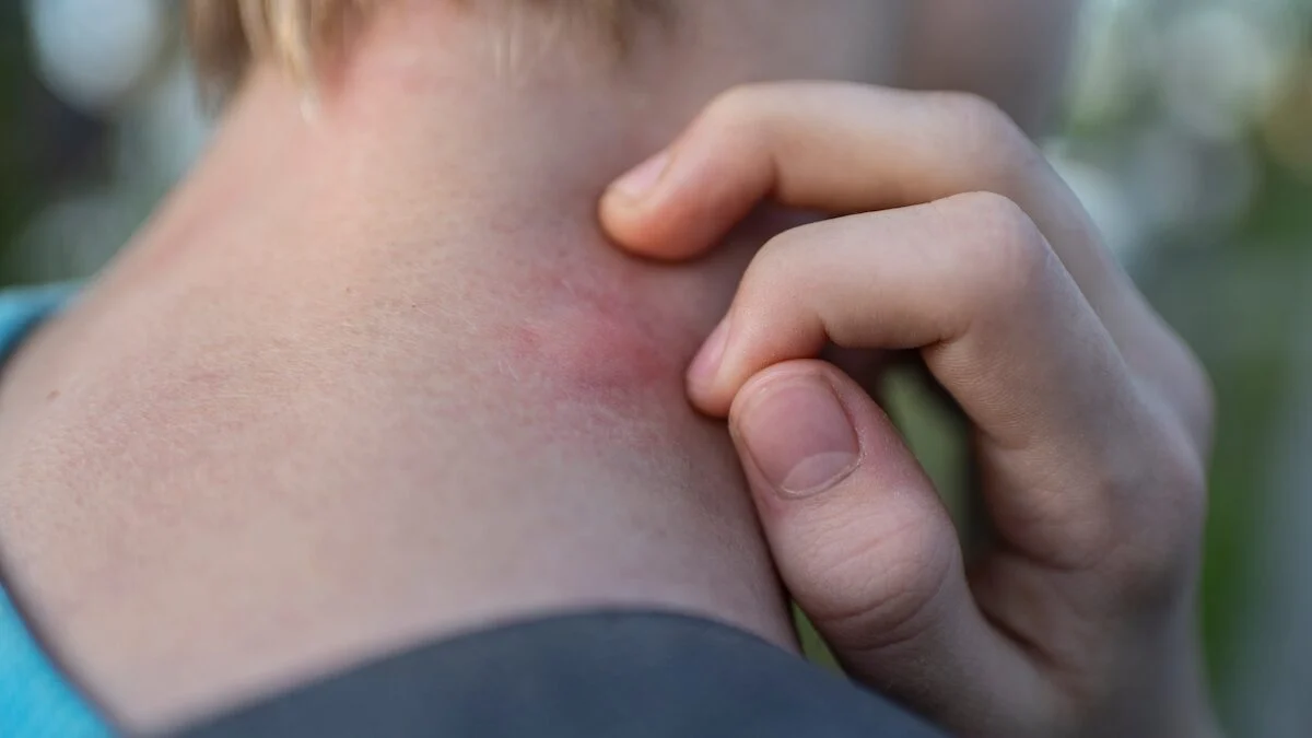 A mosquito bite can leave a brown spot for months, here's why it appears