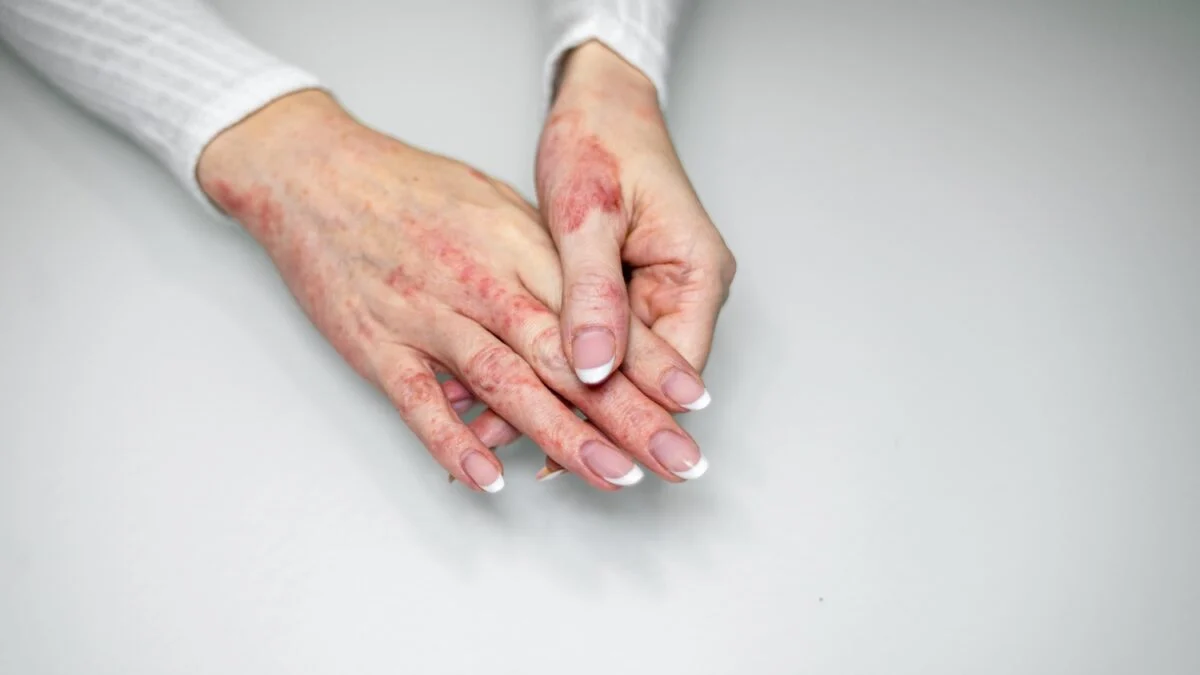 Chronic hand eczema: when the disease also threatens professional life