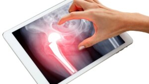 Femoral neck fracture: what AI reveals about the risks after age 50 and solutions to prevent it