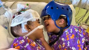 Medical feat in Saint-Louis: these Siamese sisters connected by the head separated after 24 hours of surgery