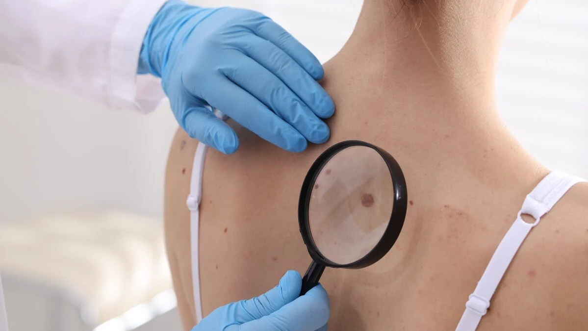 Shortage of dermatologists: can your physiotherapist really spot melanoma? The clear opinion of two specialists