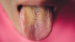 True or false health: having a yellow tongue necessarily means that the liver is functioning poorly?