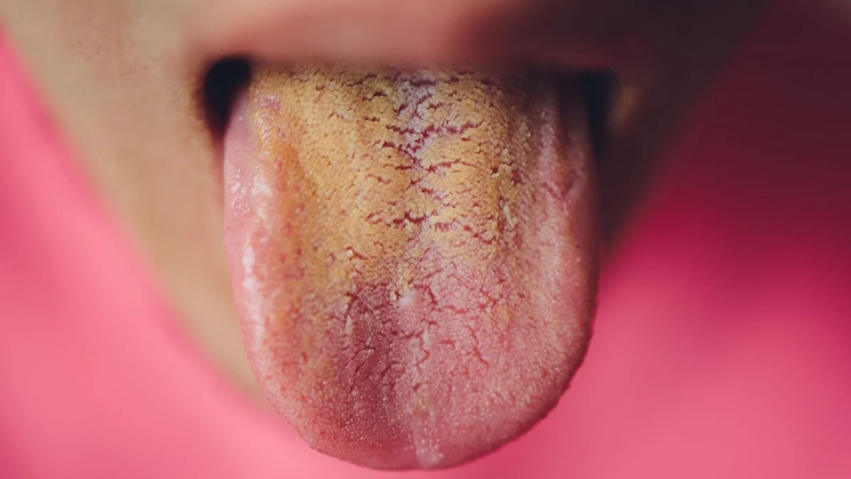 True or false health: having a yellow tongue necessarily means that the liver is functioning poorly?