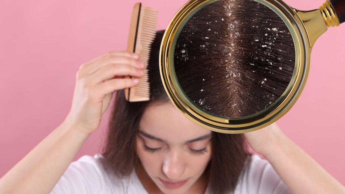 True or false health: having dandruff necessarily means that you don't wash your hair enough?