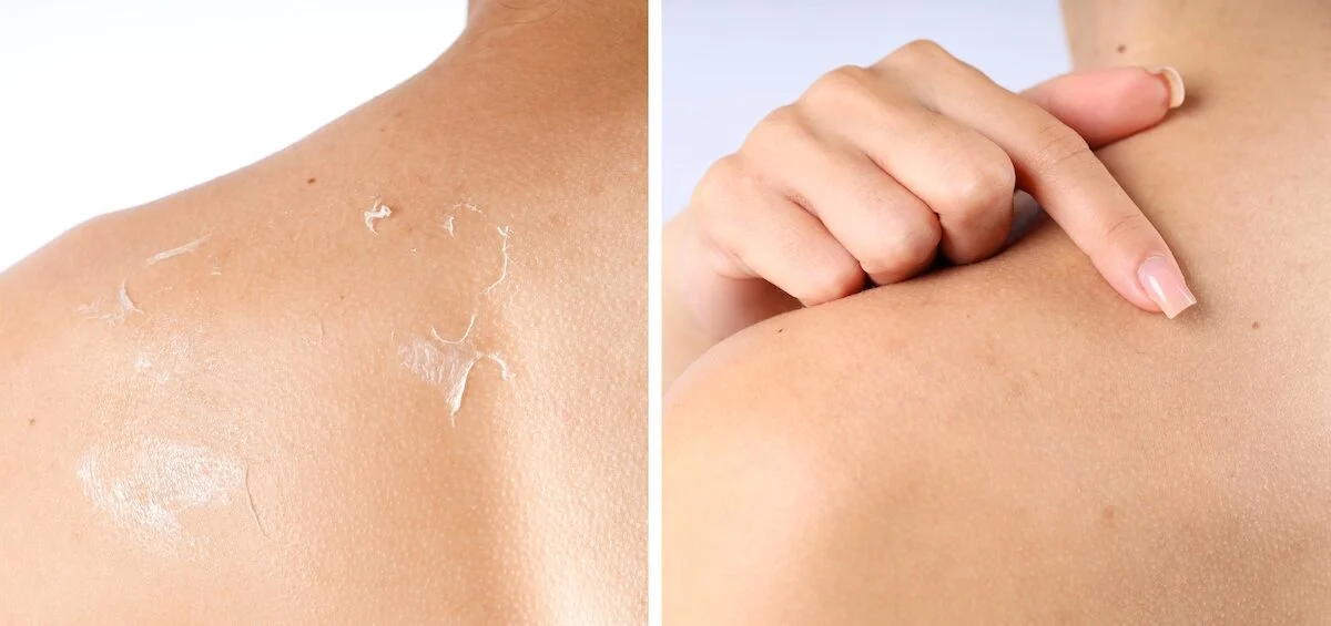 True or false health: peeling skin is always simply due to dry skin?