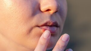 Cold sores without fever? Dr. Valinducq reveals little-known factors that favor their appearance